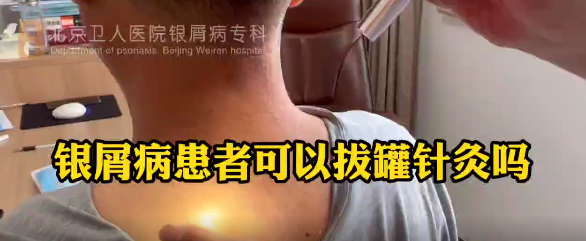 彭安明医生科普：银屑病患者可以拔罐针灸吗